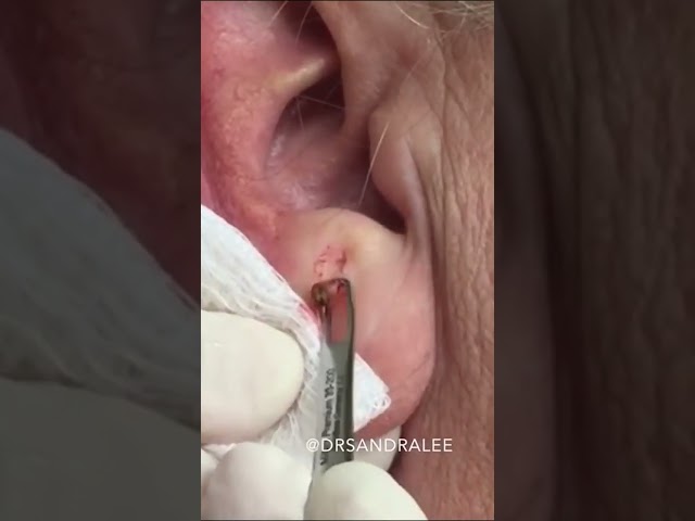 A Nice Earlobe Blackhead