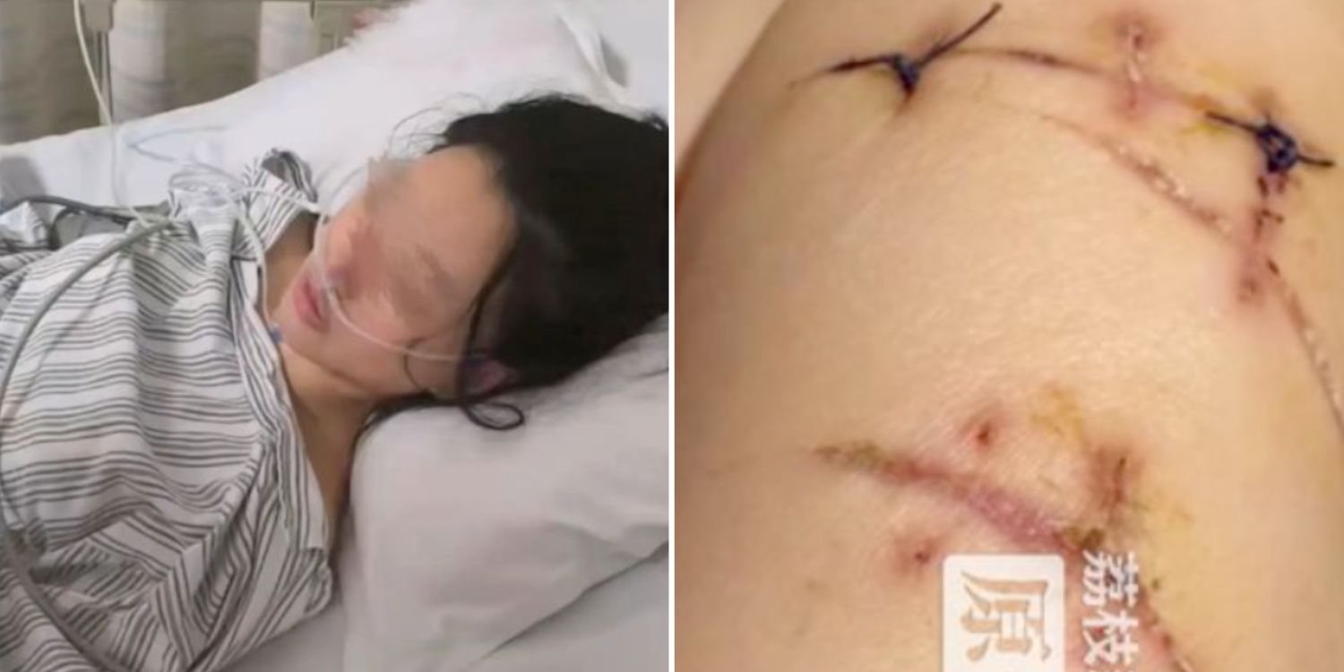 Woman in China stabbed 20 times in the chest but survived thanks to her breast implants