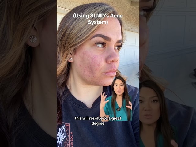 I love seeing real results from real people using my SLMD Acne System! ❤️