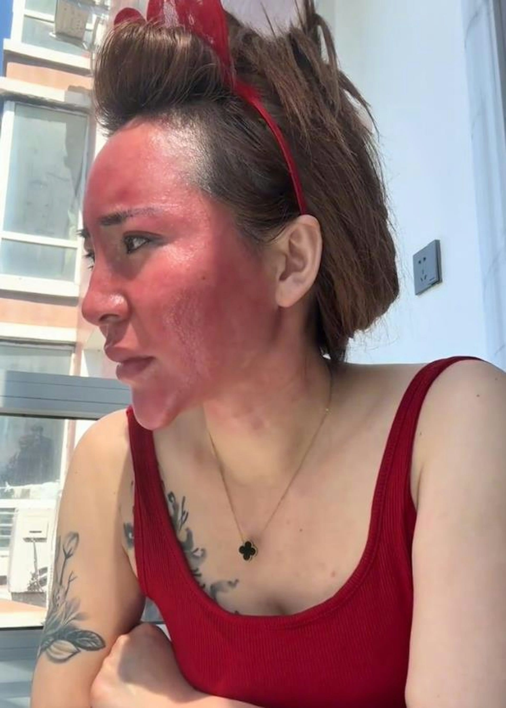 Woman Doesn't Remove Make-Up For 22 Years & Ends Up With Severely Inflamed Face; Medical Professionals Questioning Her Claims