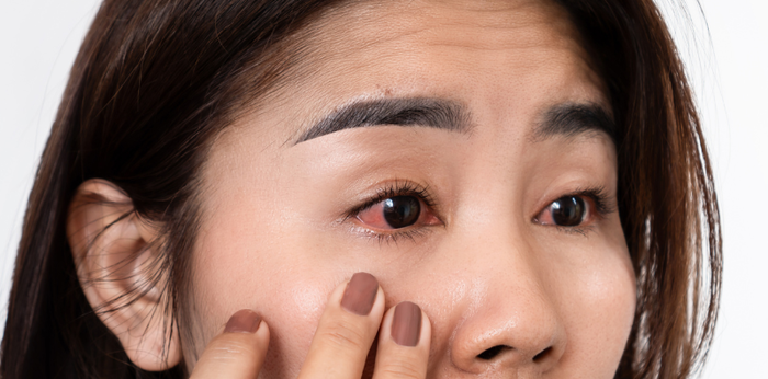 Pregnant women with red eyes, is it a risk to the baby in the womb?