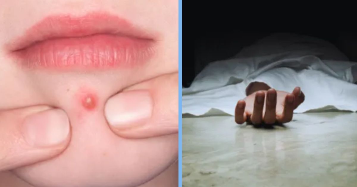 15-Year-Old Vietnamese Girl Squeezes Pimples, Develops Severe Infection and Dies