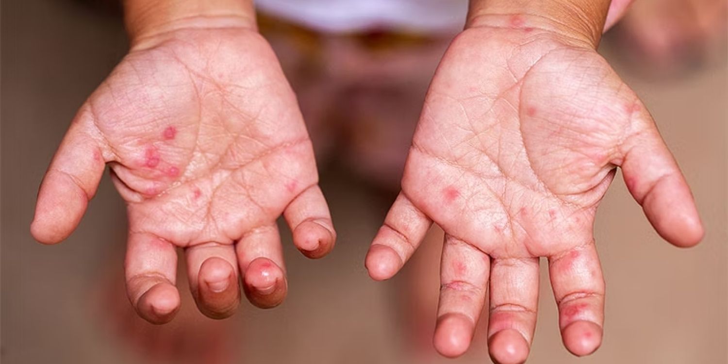 21,315 Cases of hfmd reported in thailand, authorities cite early arrival of rainy season for outbreak