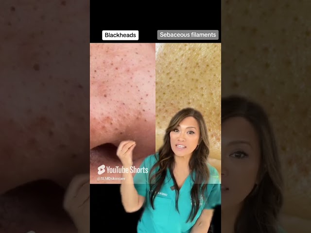 Blackheads vs sebaceous filaments — here’s the difference and how to treat them 💛💥