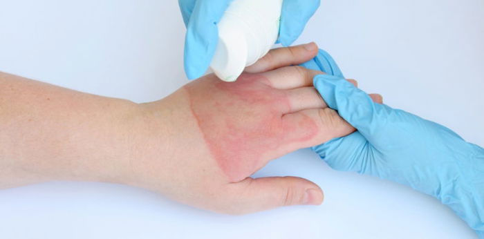 What is the medicine for a child who gets burned?