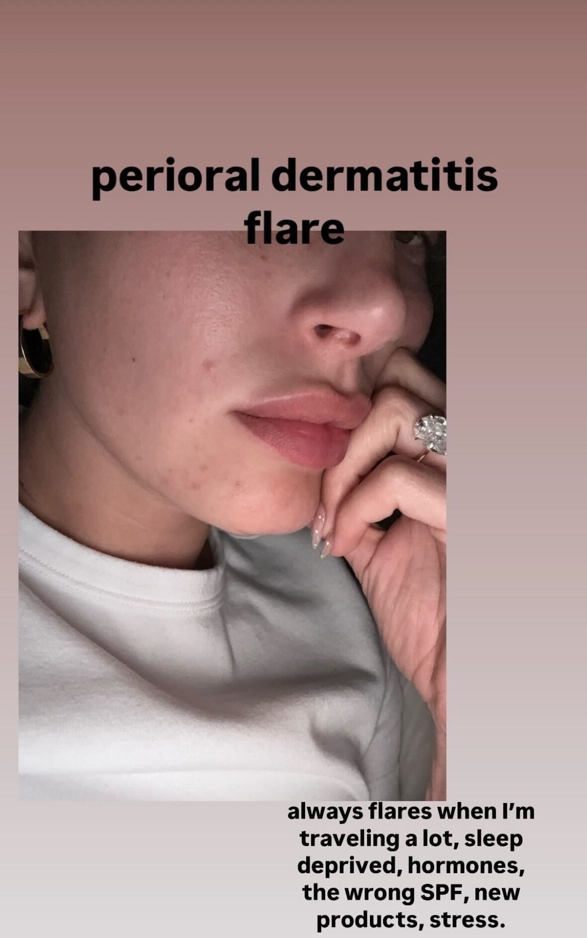 Hailey Bieber Shared Her Perioral Dermatitis Flare-Up With the World