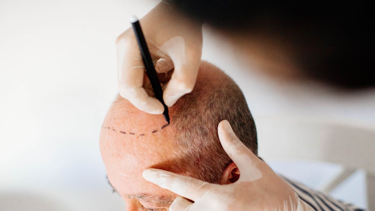 Brit dies in Turkey after hair transplant as 'reckless homicide probe launched'