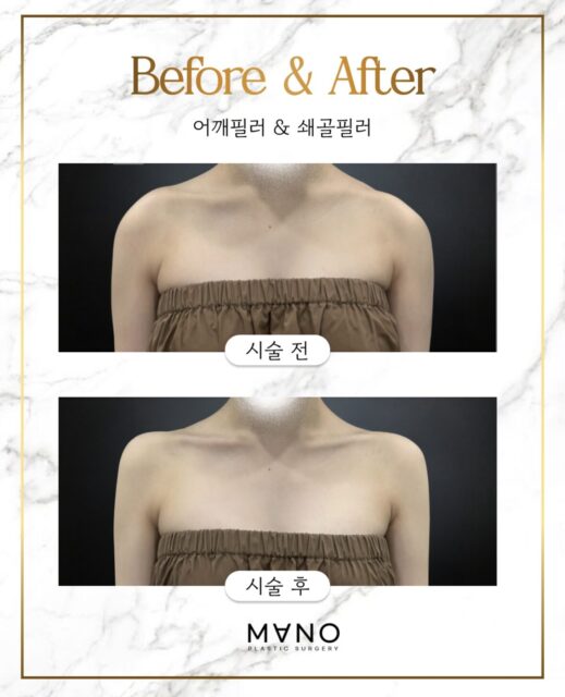 Koreans Now Getting Shoulder Fillers to Look Like BLACKPINK’s Jennie, Outrage Erupts Online