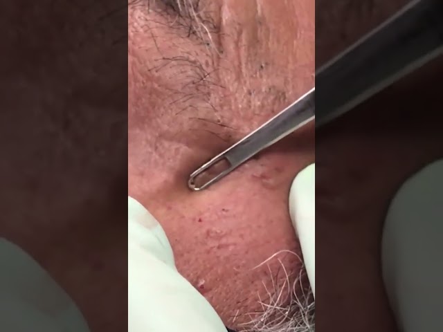 Part 2   left side of this wonderful patient who came in for something else but graciously let u