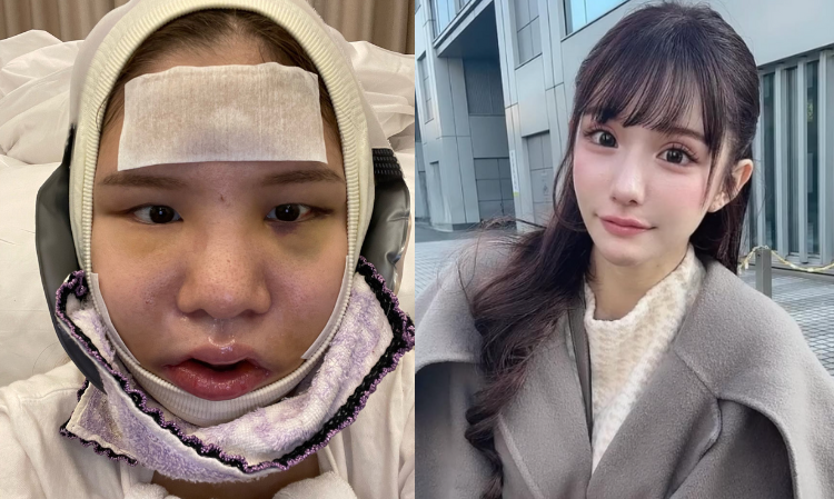 还被妈妈嫌弃过！28岁百万网红⚡「狠花千万」去整容！惊人对比照曝光：像换头了！