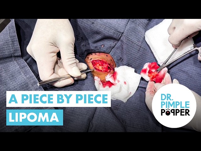 A Piece by Piece Lipoma
