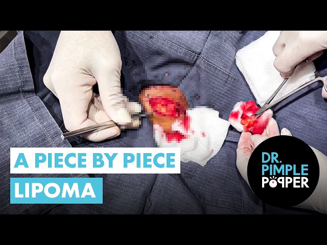 A Piece by Piece Lipoma