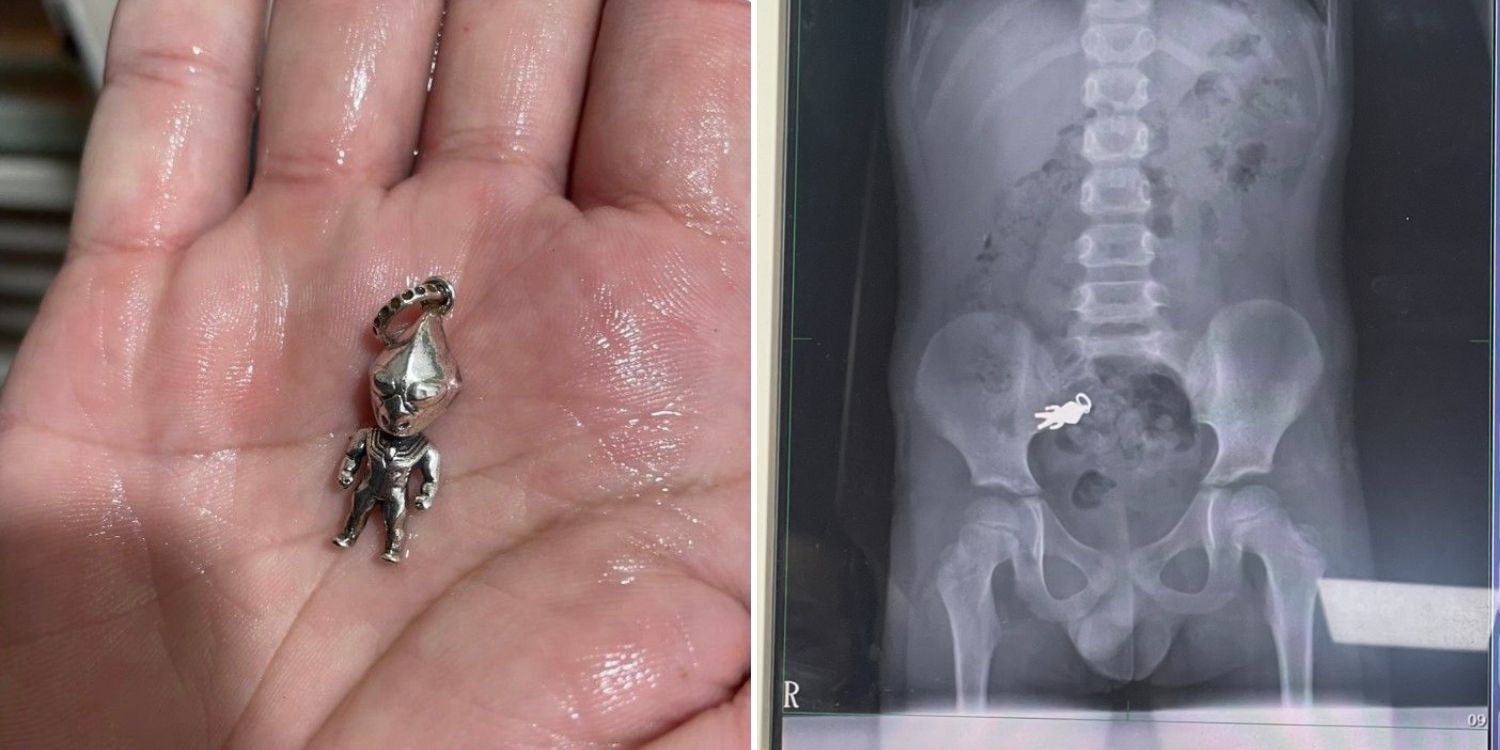 7-Year-old boy in Taiwan swallows ultraman keychain while eating snacks, x-ray shows Superhero’s ‘journey’