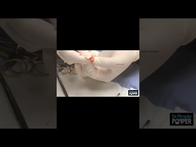 Have you ever wondered what the inside of a Pilar Cyst looks like?