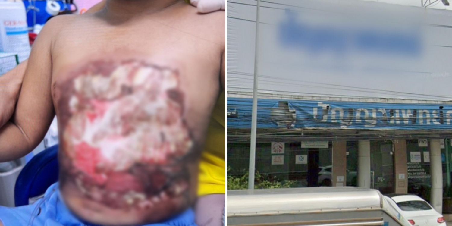 3-Year-old boy in Thailand scalded with boiling water during treatment at clinic