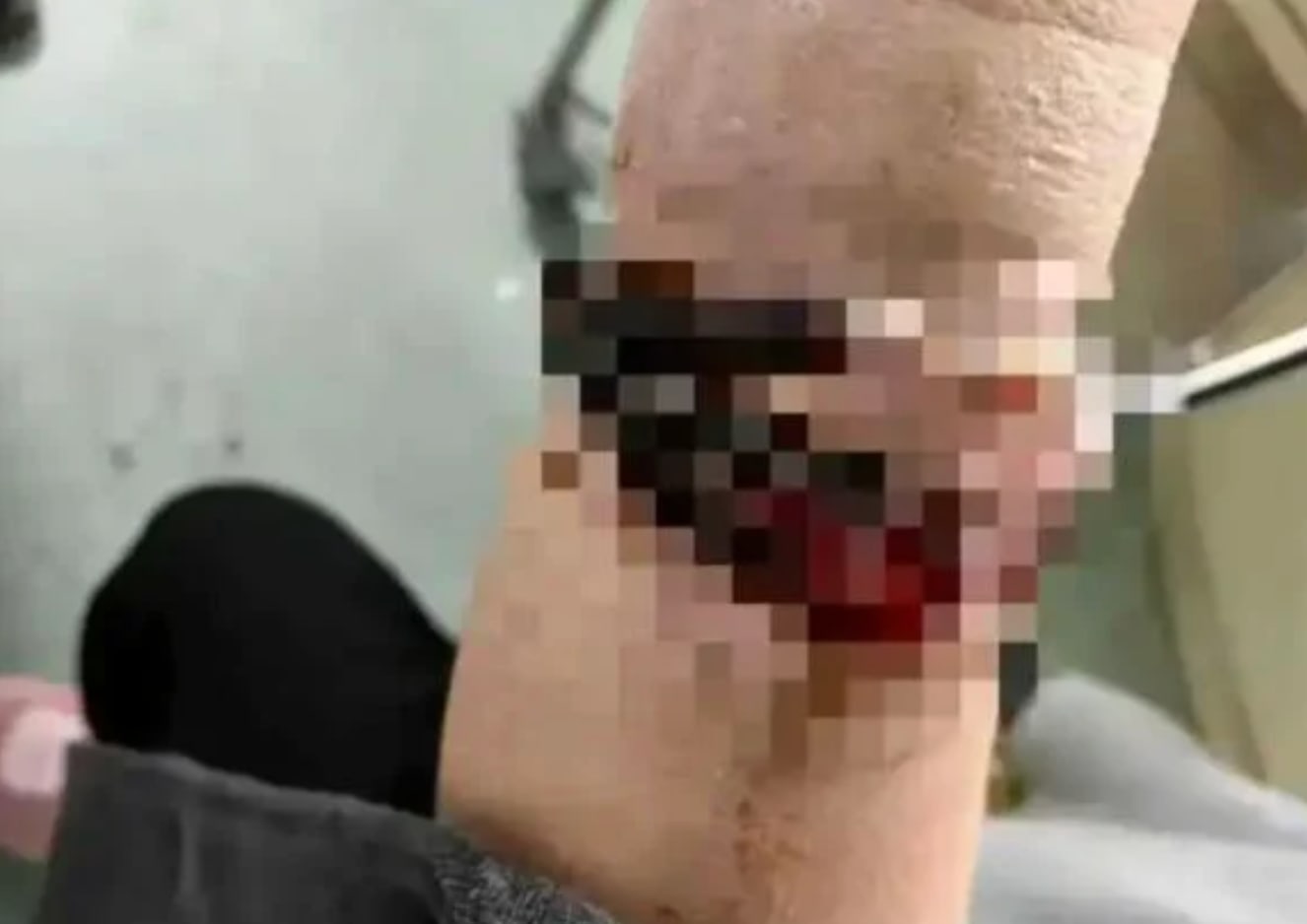 She Wore This Bracelet For 10 Years And It Got Lodged In Her Flesh