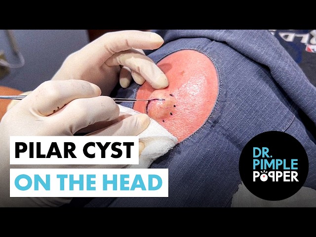 Pilar Cyst on the Head