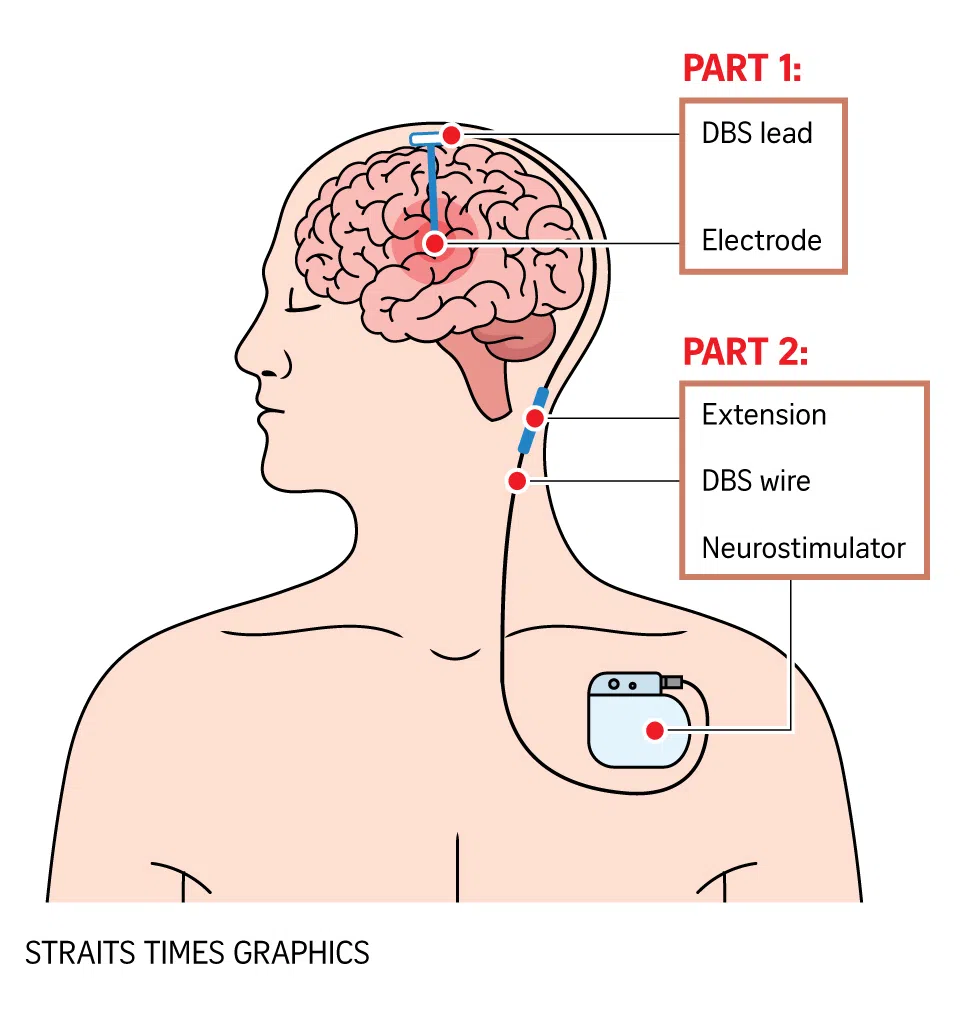 Life rewired: Deep brain stimulation curbs excessive, involuntary movements in boy with rare disorder