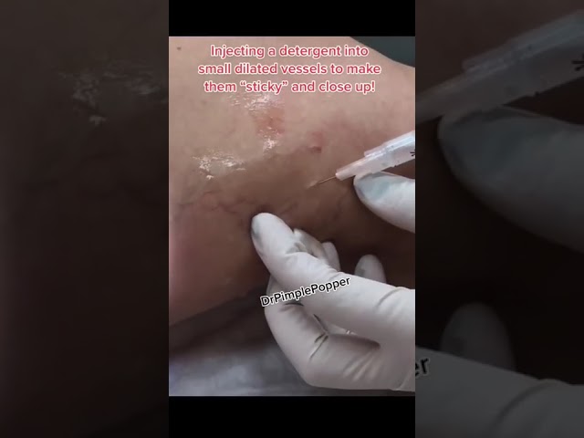 Dr Pimple Popper Performs Sclerotherapy  #shorts